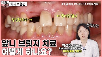 벌어진 앞니 보철 치료하는 방법 2탄 [브릿지 치료, 임플란트, 치료진단, 치료계획]｜덴탈메이트