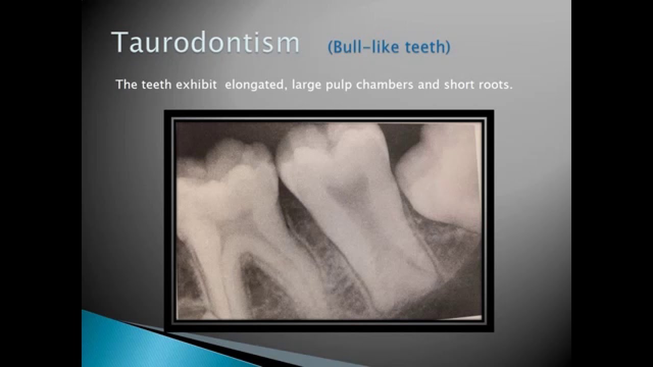 Radiographic Interpretation of Dental Anomalies Part 1 YouTube
