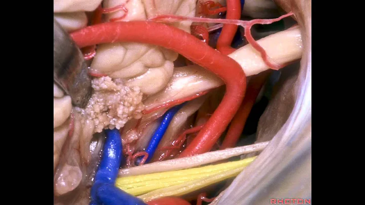 Approaches to the Brainstem