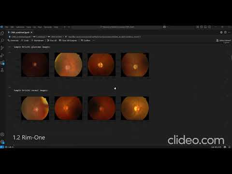 Glaucoma Detection Using Machine Learning and Fundus Imaging