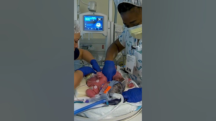 Conjoined twins born at UC Davis Children’s Hospital