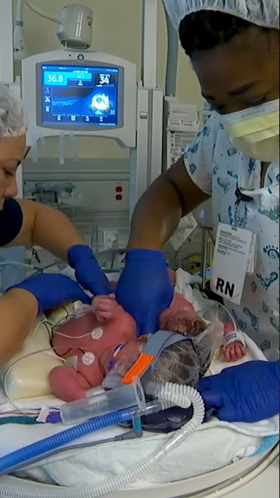 Bayi kembar siam lahir di Rumah Sakit Anak UC Davis