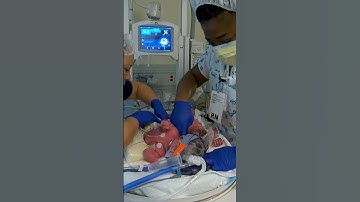 Conjoined twins born at UC Davis Children’s Hospital