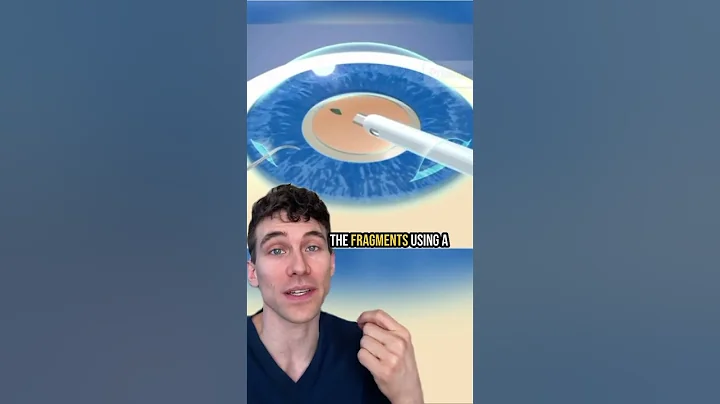 How Cataract Surgery Is Done (Cataract Surgery Animation)