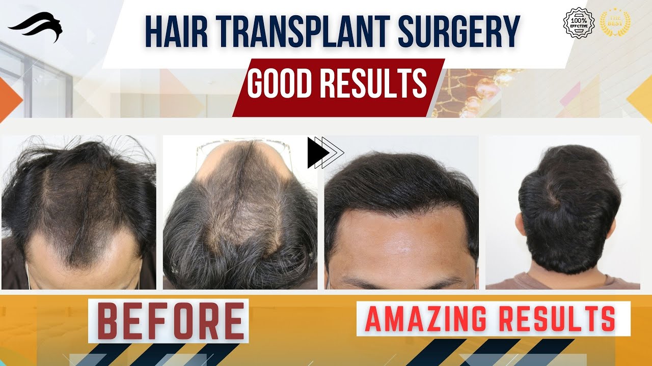Hair Transplant In Rajkot Best surgeon Clinic Cost & Results Of Hair