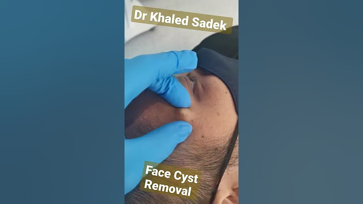 #cystremoval #blackheads #pimples #drkhaledsadek Dr Khaled Sadek Lipomacyst.com