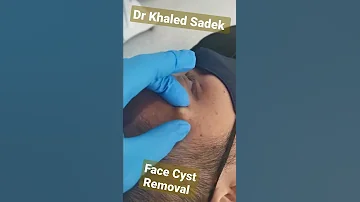 Cystremoval Blackheads Pimples Drkhaledsadek Dr Khaled Sadek Lipomacyst Com 