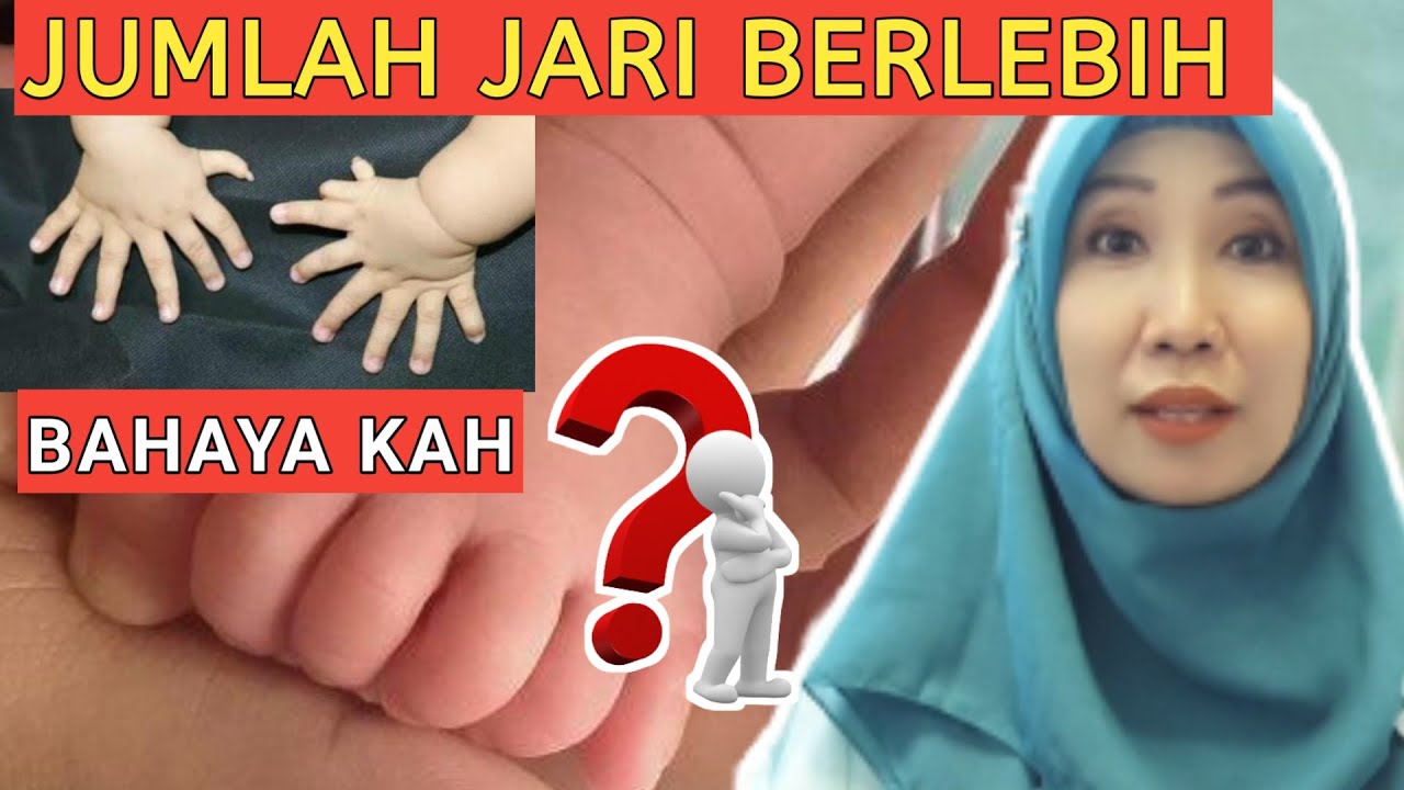 kenali kelainan bawaan pada Bayi memiliki banyak jari || Jari tambahan Polidaktili
