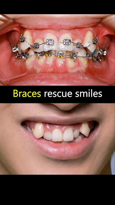 Braces fix crooked teeth. Rescue his smile ##braces #orthodontist #smile #teeth #dentist