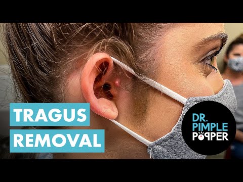 TMI! Accessory Tragus Removal - YouTube