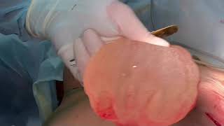 Удаление силиконовых имплантов из груди