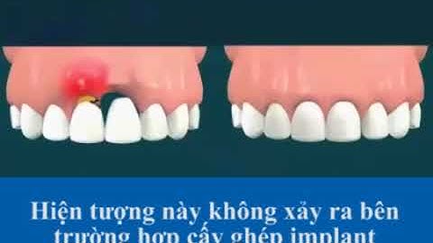 SO SÁNH GIỮA 2 PHƯƠNG PHÁP CẦU RĂNG SỨ VÀ CẤY GHÉP IMPLANT