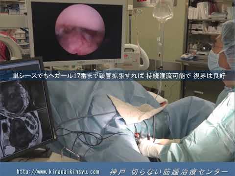 子宮頸部筋腫  子宮鏡下摘出術 (cervical submucosal fibroid  hysteroscopic resection)