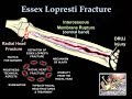 Fracture of the radial head essex lopresti  everything you need to know  dr nabil ebraheim