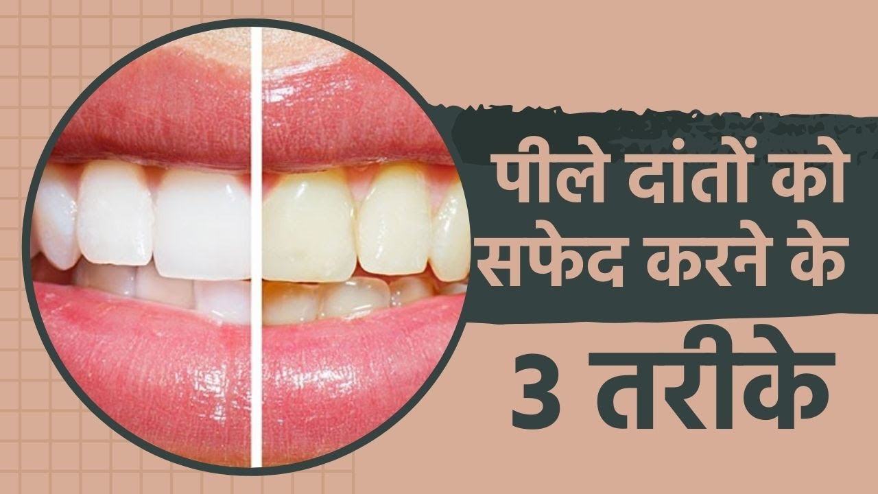 What Is Teeth Whitening? Types, Process And Side-Effects Of This Treatment - What Is Teeth Whitening? Types, Process And Side-Effects Of This Treatment