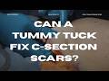 What Happens to C-Section Scars During a Tummy Tuck? (Explained) | By Dr. Andre Marshall