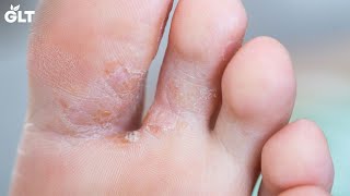 7 Ways To Treat Foot Fungus Easily At Home Resimi