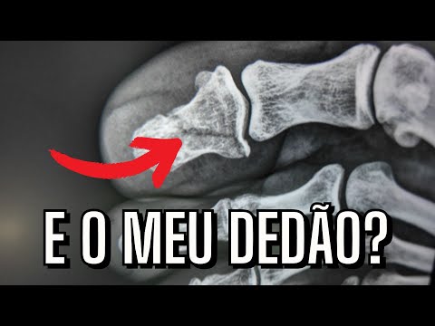 e o DEDÃO do PÉ? Já sarou?