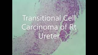Retrobladder Tumor from Right ureter