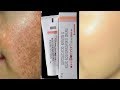 Demelan cream |Remove pigmentation |Acne scars| pimple marks|