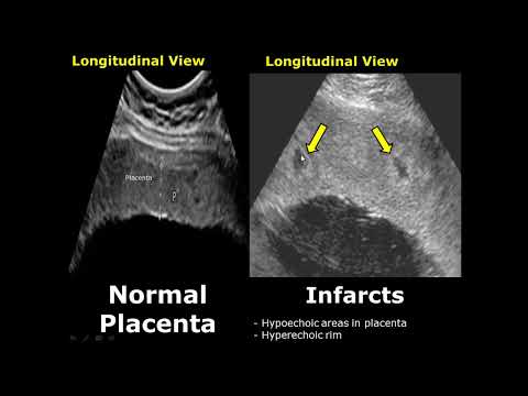 Placenta Ultrasound Normal Vs Abnormal Image Appearances Comparison | Placental Pathologies on USG