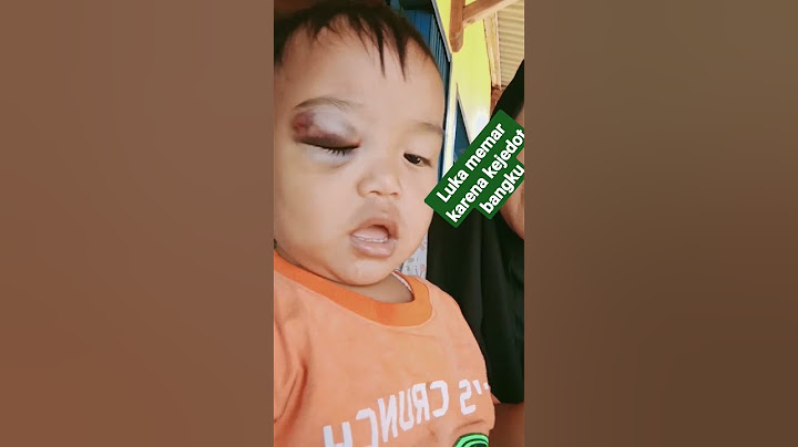 Luka memar di mata karena kejedot bangku