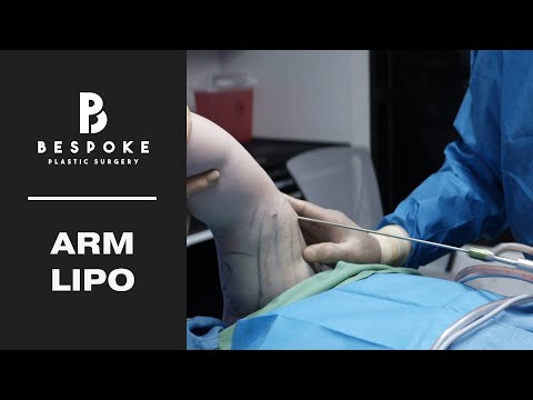 Getting Arm Liposuction