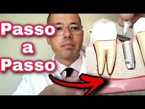 IMPLANTE DENTÁRIO PASSO