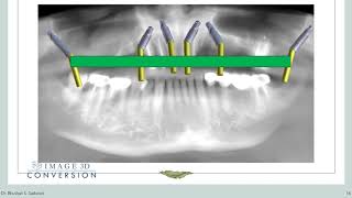 Season 1 Ep 3 | Mastering Pterygoid implants and digital planning, A comprehensive exploration |