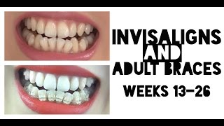 Invisalign & Adult Metal Braces (BOTH AT THE SAME TIME) Journey: Weeks 13-26 | YayForAmy