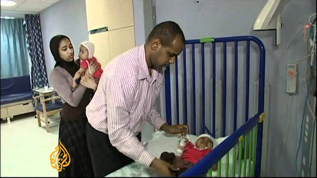 جراحون بريطانيون يفصلون توأمين سودانيين ملتصقين