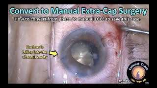 CataractCoach 1235: convert from phaco to manual ECCE extra-cap cataract surgery