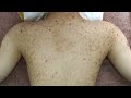 등 모낭염, 색소침착, 흉터, 자국 관리 후기 (Back acne, pigmentation, scarring reviews) - 모아드