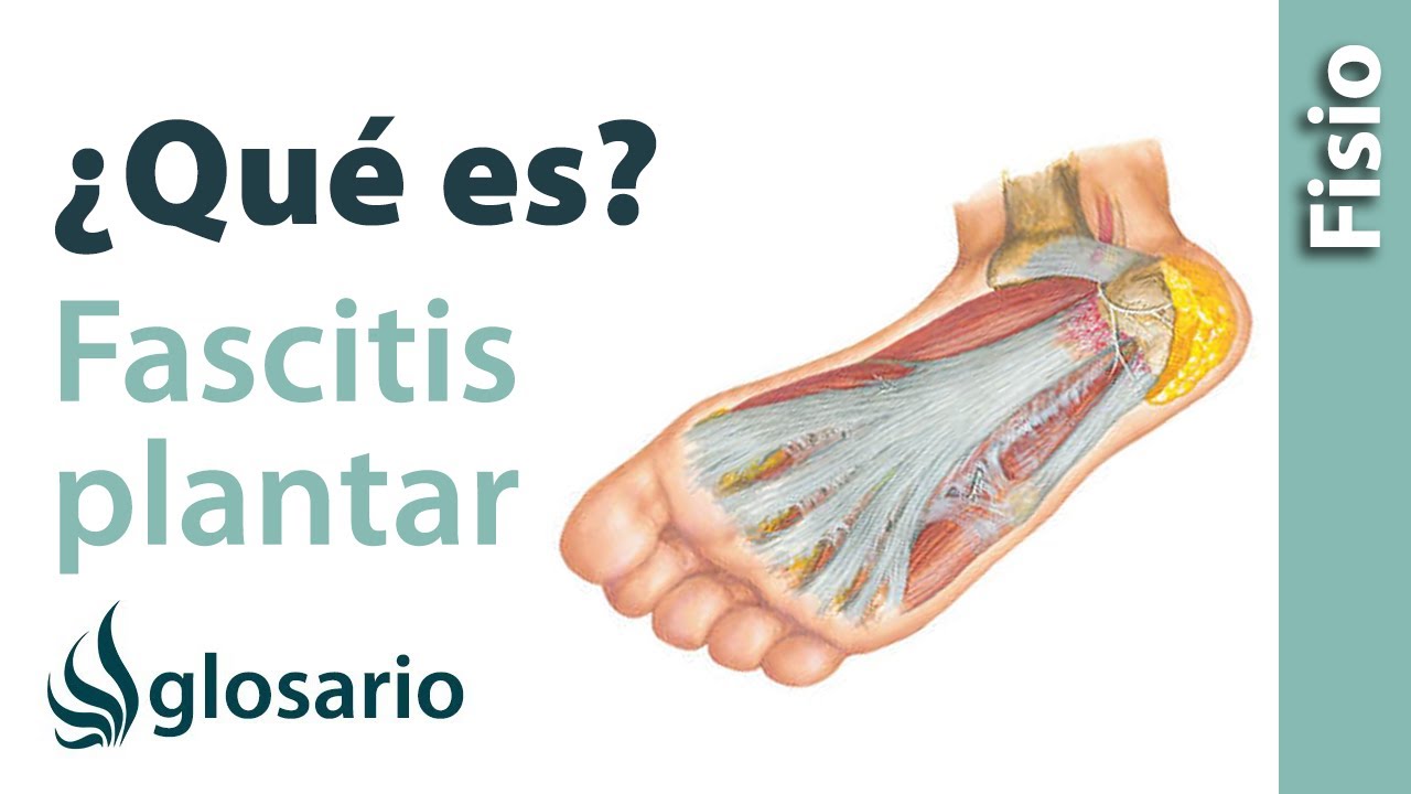 FASCITIS PLANTAR ¿Qué es? YouTube