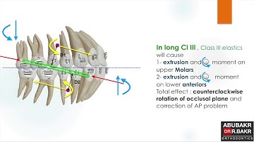 Long and short class III elastics