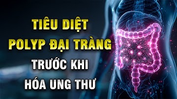 Tiêu Diệt Polyp Đại Tràng Trước Khi Hóa Ung Thư – Sự Thật Ít Ai Nói Với Bạn | Khoẻ Đẹp Mỗi Ngày
