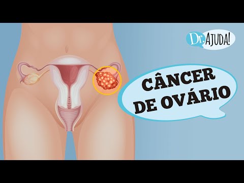 Vídeo: Como detectar câncer de ovário: 11 etapas (com fotos)