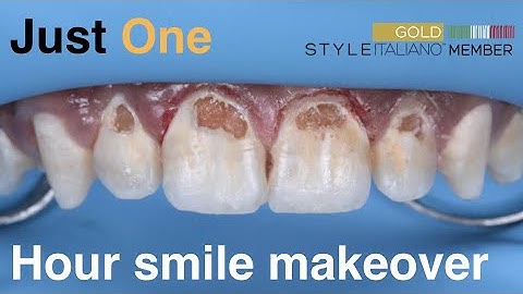 Smile makeover in a single visit- multiple class V caries - DIRECT BONDING.