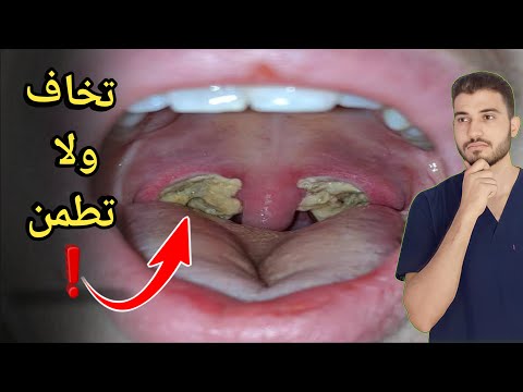 ظهور طبقة بيضاء مكان عملية اللوز هقولك تعمل اي وامتي تخاف دروس طبية