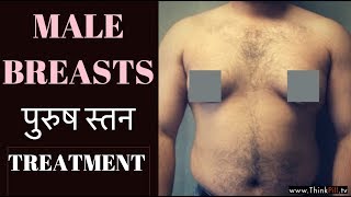 पुरुष स्तन का इलाज Male Breasts ( GYNO) Gynaecomastia TREATMENT COST ilaj गाइनेकोमैस्टिआ - Dr Rupal