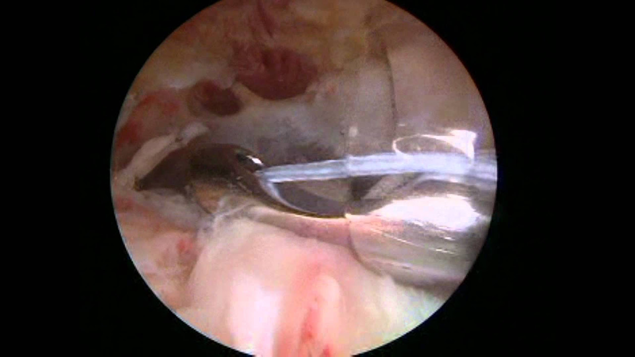 Arthroscopic rotator cuff repair - double row - Dr. Laith Farjo, Brighton, Michigan