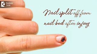 Nail split off from nail bed after injury |  Tips by Dermatologist- Dr. Nischal K| Doctors' Circle