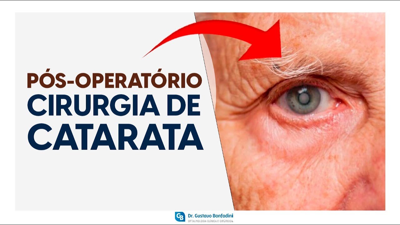 Pós-operatório da cirurgia de cirurgia de catarata  – Dr. Gustavo Bonfadini