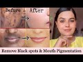 Naturally remove dark spots mouth pigmentation acne scars  pimple marks within 7 days