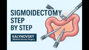 Laparoscopic Sigmoidectomy with TME – Step by Step Surgical Technique