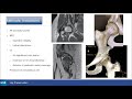 “Salvage” PAO: Outcome for iatrogenic hip instability / E. Sink
