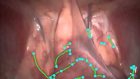 branching segment detection hamlyn