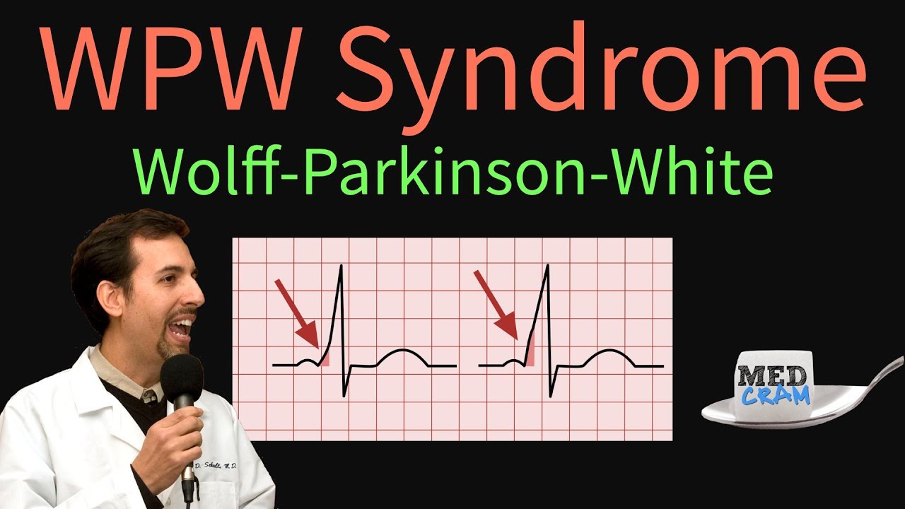 ⁣WPW / Wolff-Parkinson-White Syndrome: ECG / EKG findings, symptoms, pathology, & treatment
