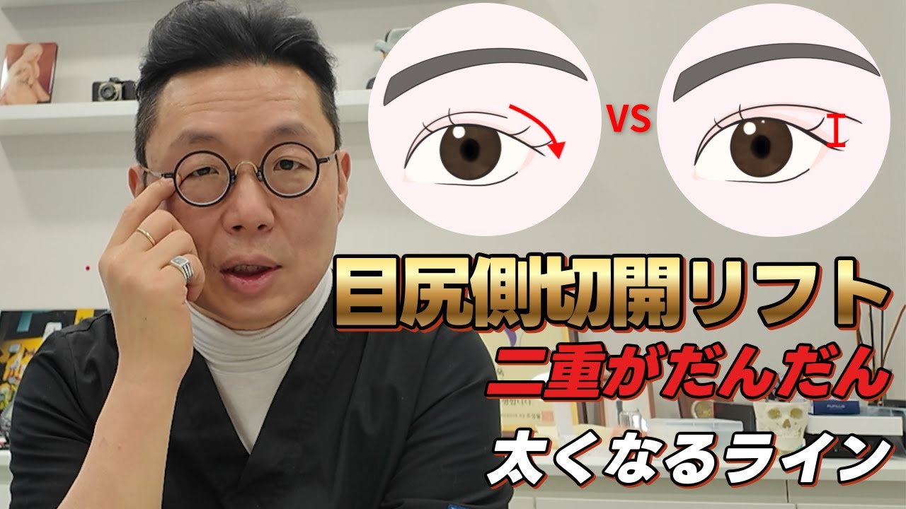 【目尻側切開リフト】二重がだんだん太くなるライン