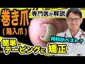 巻き爪治療 のプロが教えるベストな切り方 テーピング に矯正も紹介